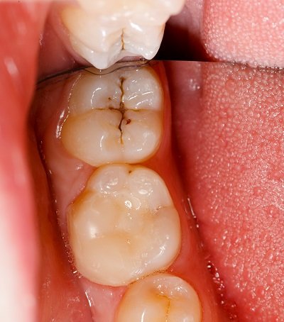 Complete Dental Works Cavity And Teeth