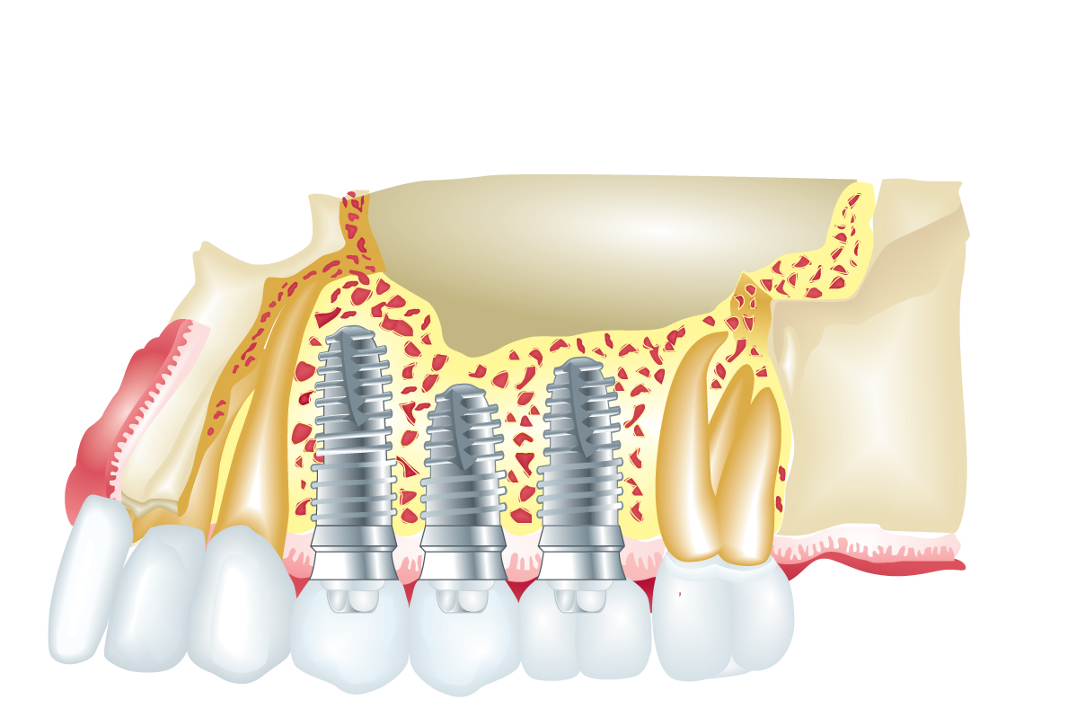 Complete-dental-works-Dental-implant-Annerley