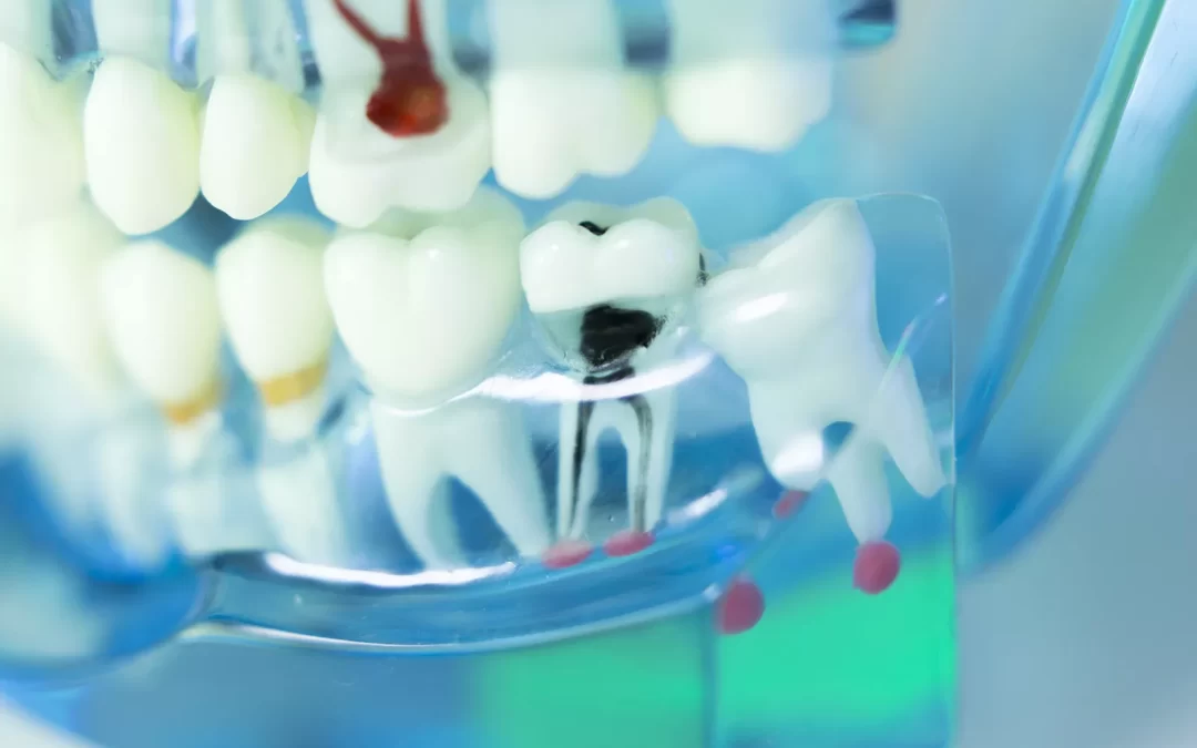 Root canal treatment vs tooth extraction