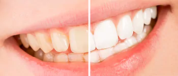 Annerley-dentist-Teeth-whitening-before-after