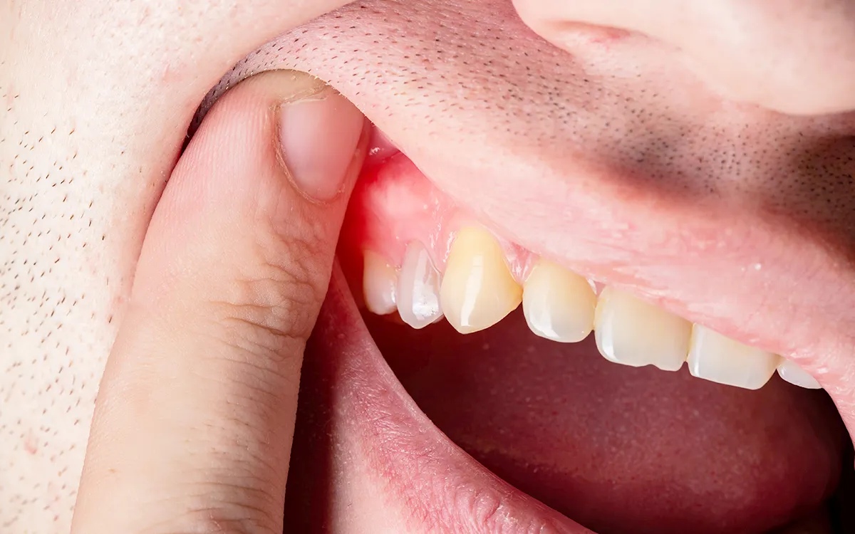 Gum inflammation