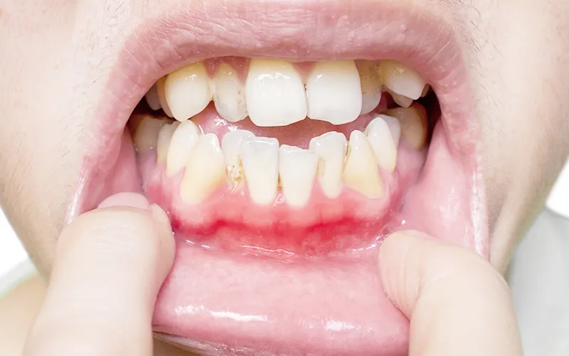 Red or swollen gums