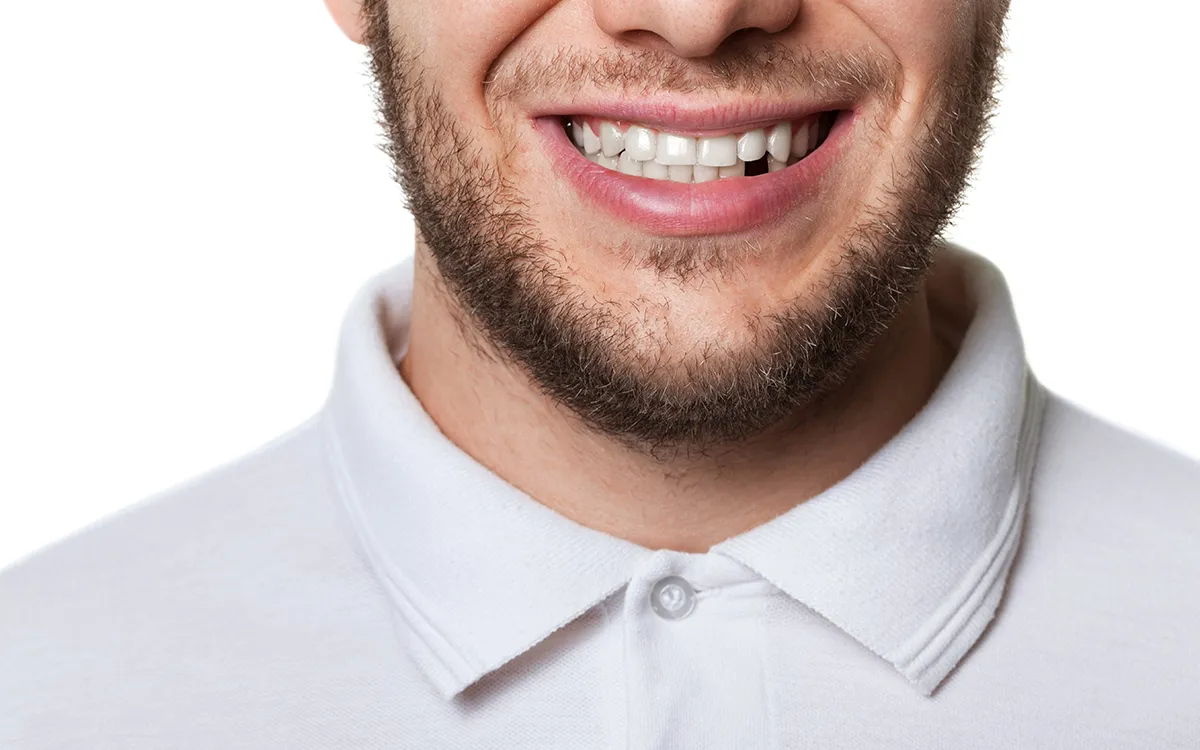 Chipped or missing teeth